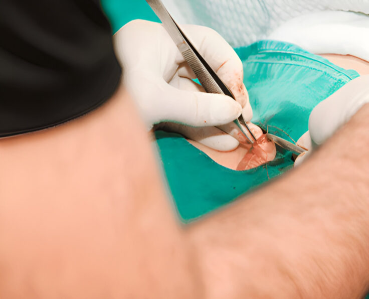 Circumcision surgery-Picsart-AiImageEnhancer (1)-Picsart-AiImageEnhancer (1) (1)