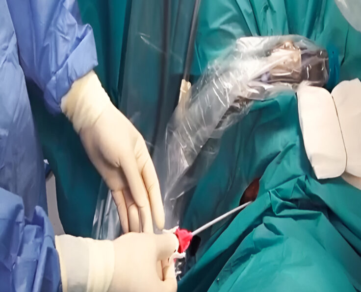 Endoscopic & LASER surgery of kidney stones ( Mini Perc, URS)-Picsart-AiImageEnhancer (1) (1)